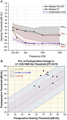 Deep intracochlear injection of triamcinolone-acetonide with an inner ear catheter in patients with residual hearing